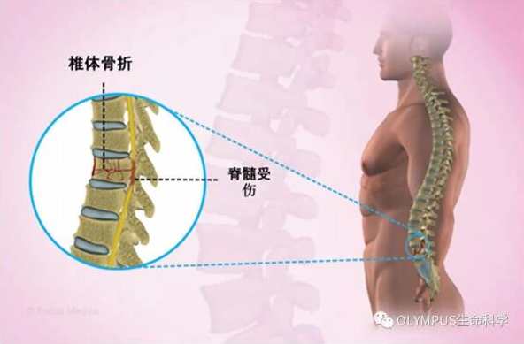 何思敏 脊柱骨折和脊髓损伤,第1张