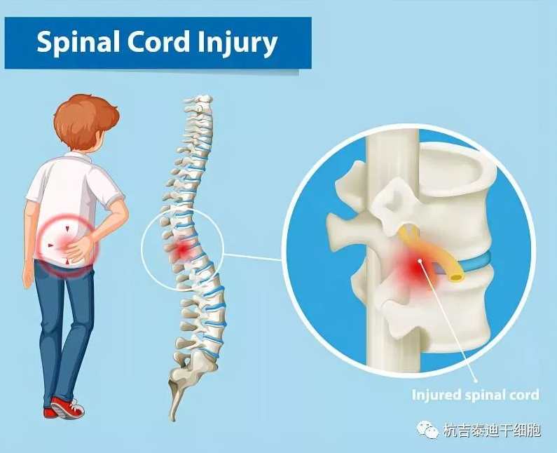 何立民 脊髓损伤并发症及其防治,第1张