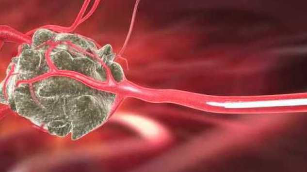 陈春林 子宫肿瘤的介入治疗,第1张 陈春林 子宫肿瘤的介入治疗,第1张