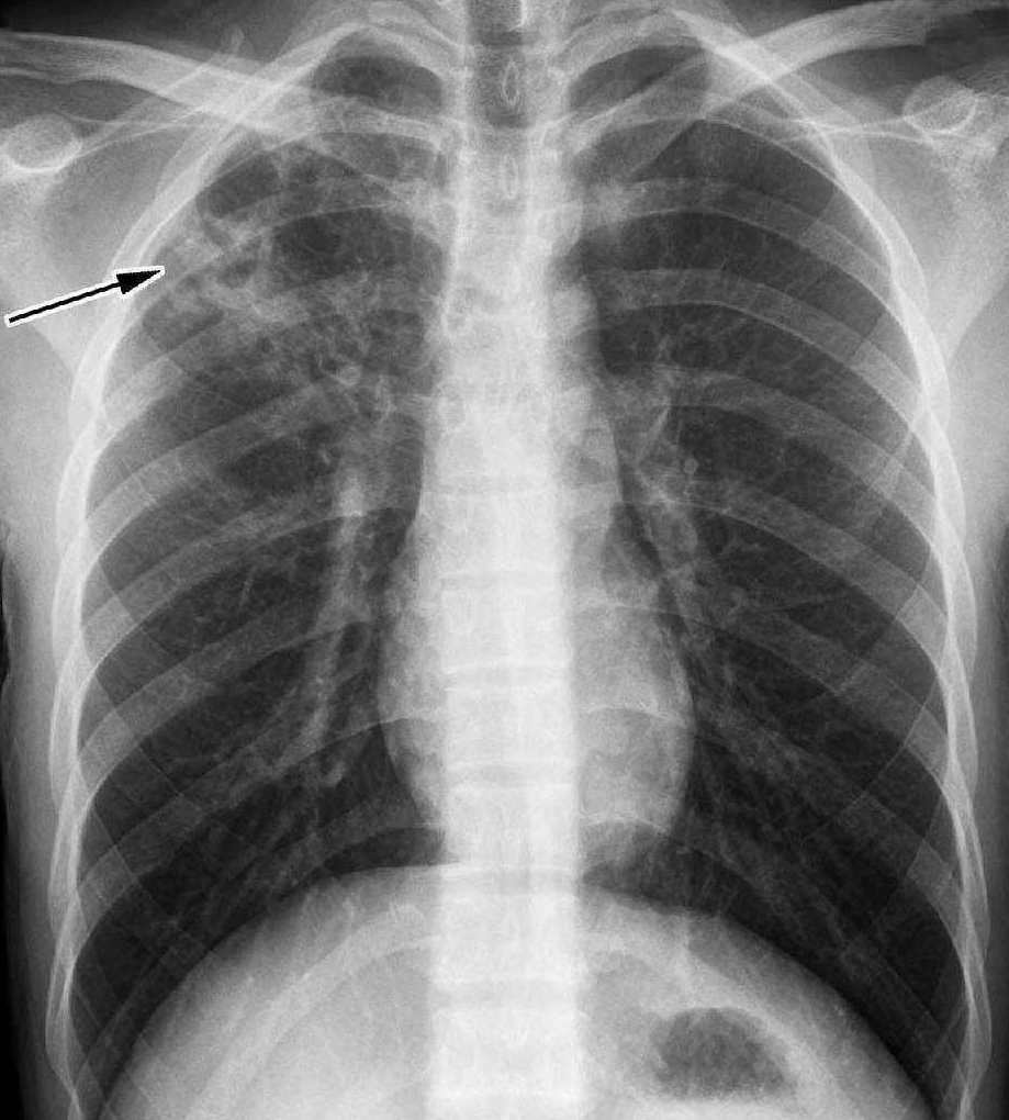 高微微 肺结核,专业,第1张